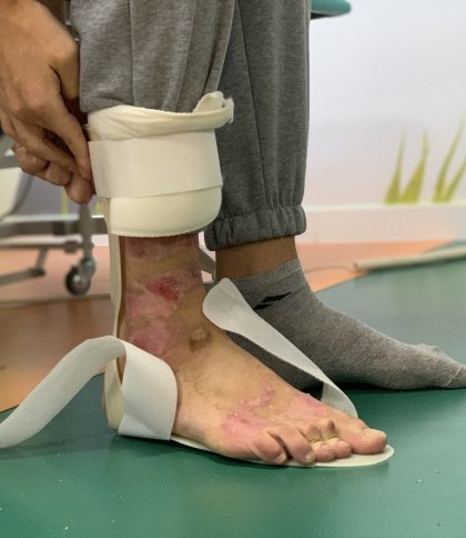 Хлопець отримав опіки 42% шкіри