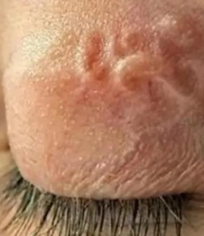 З ока львів’янина лікарі витягнули 11-сантиметрового гельмінта