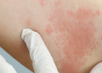 Хронічна кропив’янка: коли свербіж і висипання не минають