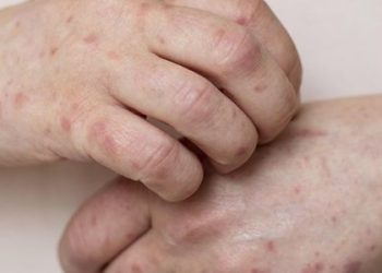 27-річний чоловік з кором потрапив до лікарні у важкому стані — Львівщіна