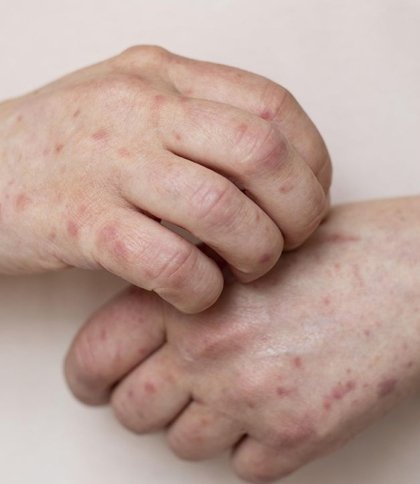 Новий випадок кору: 27-річного мешканця Львівщини госпіталізували у важкому стані