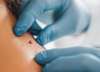 У Львові безкоштовно перевірятимуть родимки та новоутвори — LVIV.MEDIA