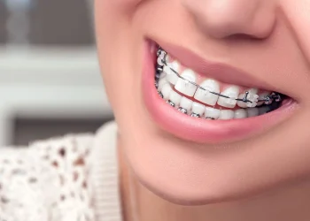 види брекетів